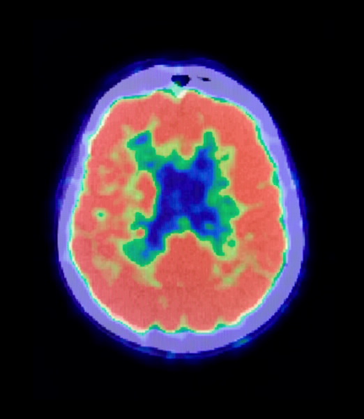 PET scan of the brain